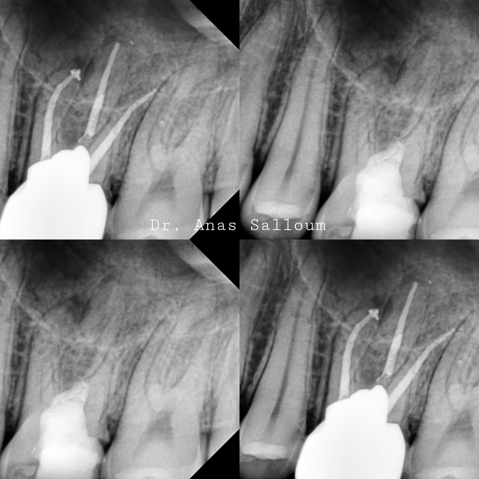 Root Canal Treatment